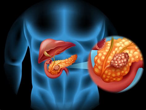 Pancreatic cancer is overall pretty rare, with 57,600 americans expected to be diagnosed in 2020. Updates in Pancreatic Cancer Guidelines, Treatment, Research