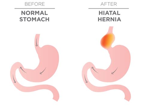 Hiatal Hernia Acid Reflux Symptoms The Surgical Clinic