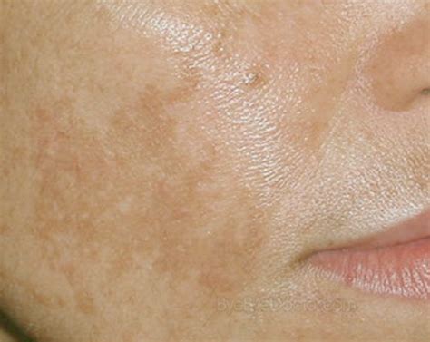 Brown Spots On Face Pictures Causes Prevention Treatment Home