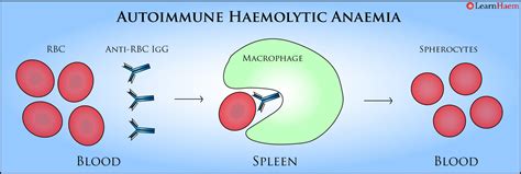 Autoimmune Haemolytic Anaemia Learnhaem Haematology Made Simple