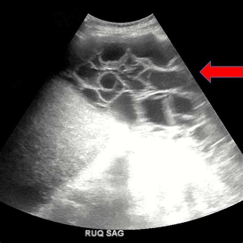 Sagittal View Of The Right Upper Quadrant Abdominal Ultrasound Also