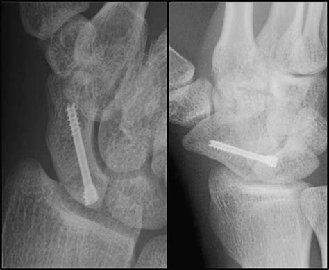 Minimal Invasive Management Of Scaphoid Fractures From Fresh To My