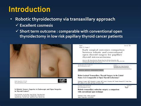 Ppt Conventional Open Thyroidectomy With Direct Approach Through The