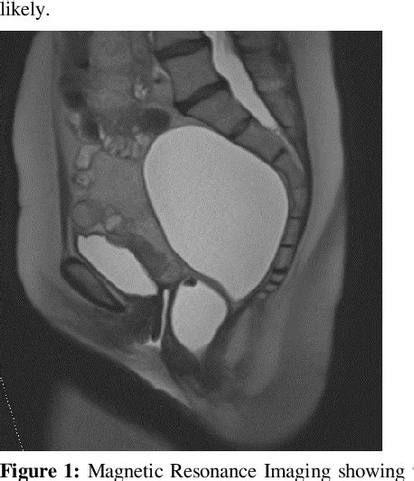 Figure 1 From Primary Retroperitoneal Serous Cystadenoma Mimicking Rectal Duplication Cyst A