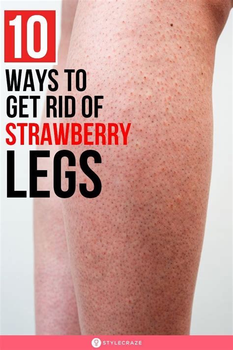 10 Natural Ways To Get Rid Of Strawberry Legs In 2021 Strawberry Legs