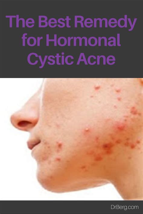 What Is The Best Cystic Acne Treatment Surffishinga