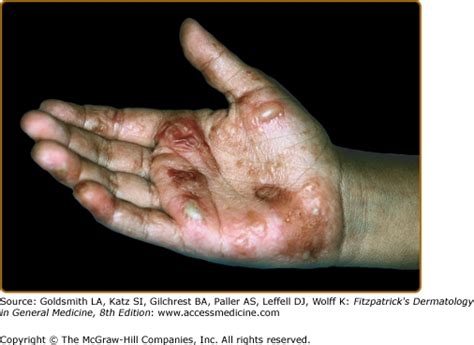 Acute Palmoplantar Eczema Dyshidrotic Eczema