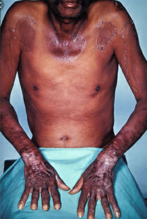 Pellagra Causes Pellagra Dermatitis Rash Diagnosis And Pellagra Treatment