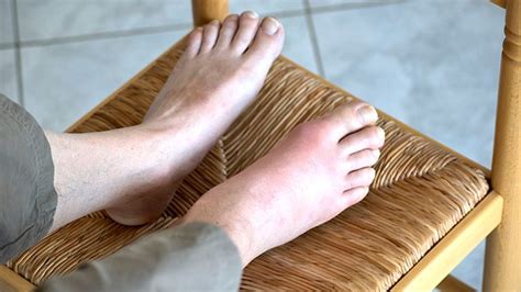 Ubat tradisional untuk sakit kaki ubat gel krim sakit kaki lutut sendi betis tumit tangan. Ubat Gout Cara Tradisional - Contoh 0917