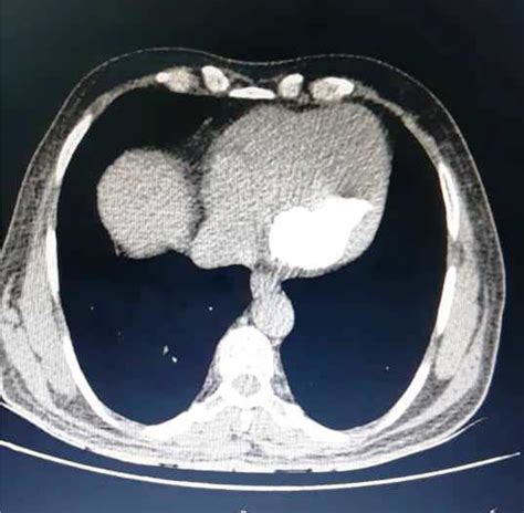 A Giant Calcified Amorphous Tumor In The Left Ventricle Presenting With