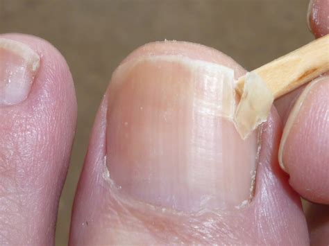 Fingernail Separated From Nail Bed Pictures Photos