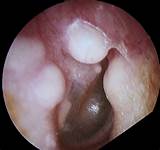 Pictures of Ear Psoriasis Treatment
