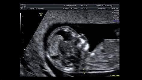 11 Week Ultrasound Pictures