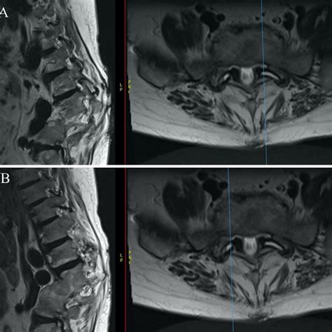 Preoperative Sagittal MRI Of Lumbar Spine Without Contrast At L5 S1