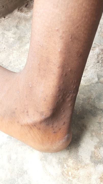 Bumps On Her Feet Itches Health Nigeria
