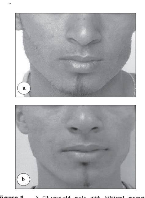 Figure 1 From The Treatment Of Masseter Hypertrophy With Botulinum