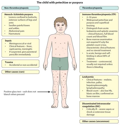 Differential For The Child With Petechiae Or Purpura Grepmed