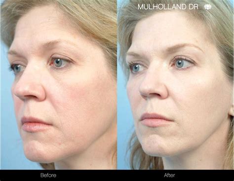 Fractional Laser Before And After Laser Facial Before And After Emerge