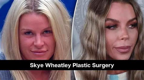 Big Brother Star Skye Wheatley Plastic Surgery Know About Her Transformation Eastrohelp