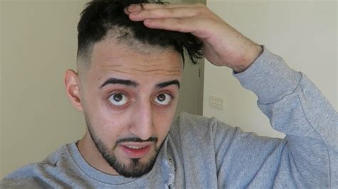 Worst hairlines in the world. BARBER F*CKS UP MY HAIRLINE (LIKE REALLY BAD) - YouTube