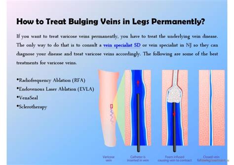 How To Treat Bulging Veins In Legs D English Esl Powerpoints