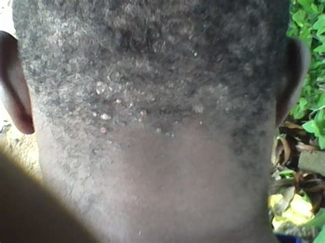 Please Help Barbers Rashes At Back Of Head Health Nigeria