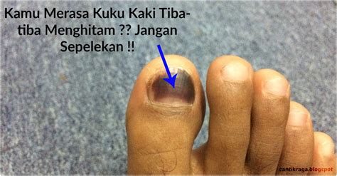 Kuku kaki dengan bentuk agak sedikit masuk ke dalam, lekukan berbentuk sendok. Kamu Merasa Kuku Kaki Tiba-tiba Menghitam ?? Jangan ...