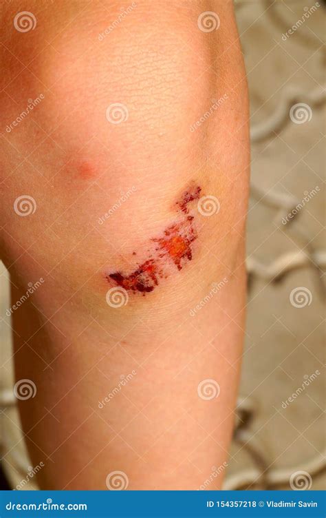 Dried Blood On The Scratch On The Knee After Falling Stock Photo