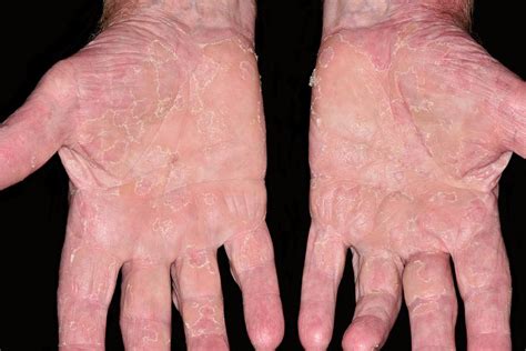 Acute Dermatitis Photograph By Dr P Marazziscience Photo Library