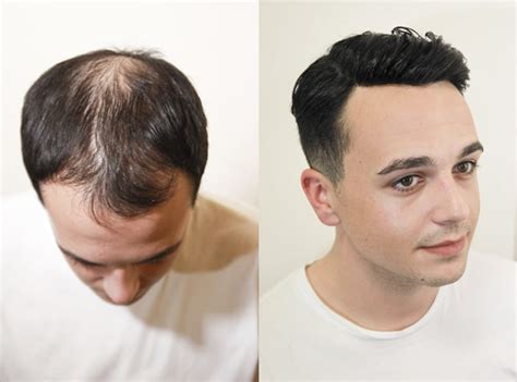Best Hairstyle For Male Baldness Pattern Hairstyle Guides