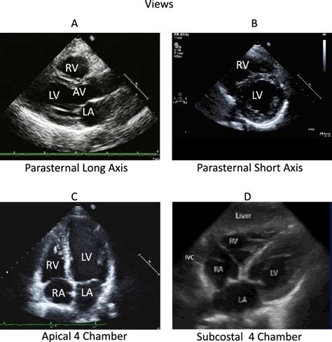 Albums 101 Pictures Echocardiogram Pictures Of The Heart Completed