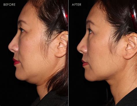 Jawline Filler for non-surgical jawline enhancement