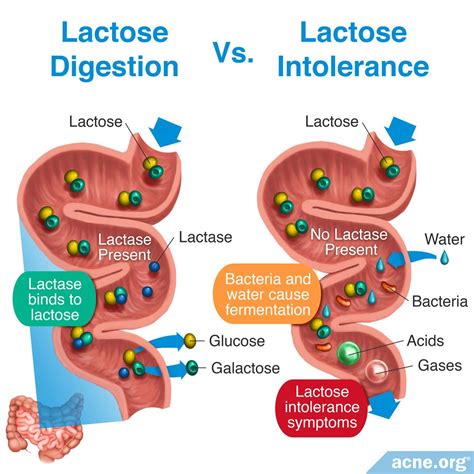 Does Lactose Intolerance Relate To Acne