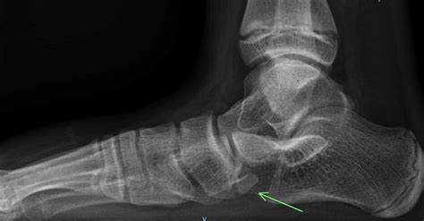 Clinical Practice Guidelines Navicular Fractures Emergency Department