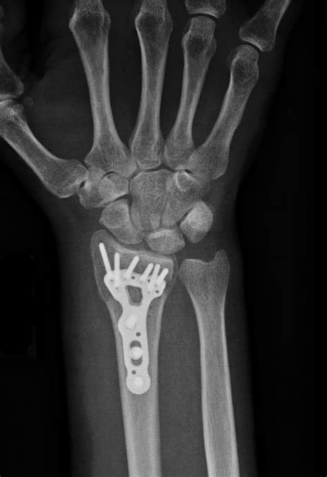 Distal Radius Fracture Wrist Fractures Images And Photos Finder