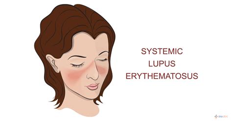 Systemic Lupus Erythematosus Sle Symptoms Treatment And Causes