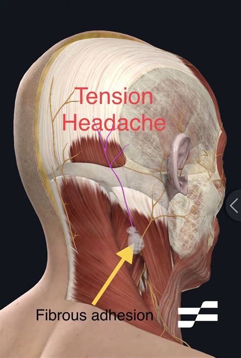 Tension Headaches — Functional Pain Relief