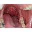 Left Sided Throat Pain 2  Weeks Submental Lymph Node HPV