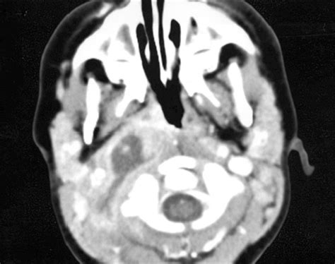 Intravenous Antibiotic Therapy For Deep Neck Abscesses Defined By