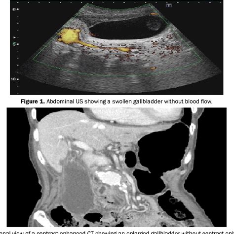Figure 1 From Gallbladder Torsion A Rare Cause Of Acute Abdomen
