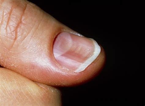 Nail Deformities And Dystrophies Dermatologic Disorders Msd Manual