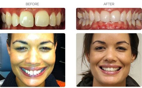 Invisalign Braces For Gaps Before And After Results