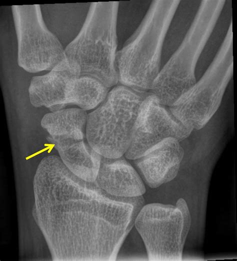 Scaphoid Fracture Radiology Cases
