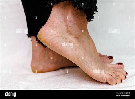 Dry Cracked Skin Woman Feet Hi Res Stock Photography And Images Alamy