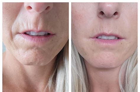 Before And After Sweet Spot Medispa