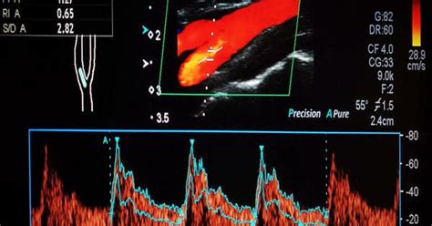 Researchers Developed Usability And Precision In Vascular Imaging Qs