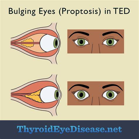 Bulging Eyes Proptosis A Symptom Of Thyroid Eye Disease