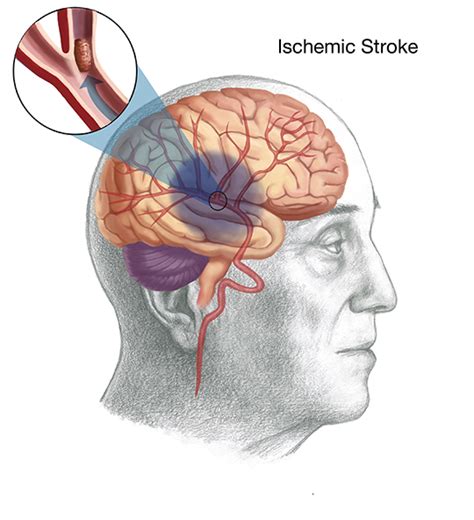 Ischemic stroke occurs due to the blockage of blood supply to the brain. Stroke | Neurosurgery and Endovascular Associates