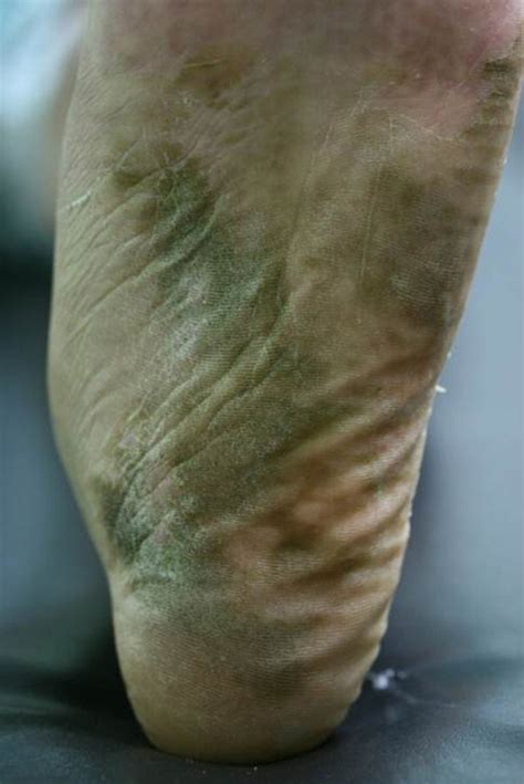 Green Foot Syndrome A Case Series Of 14 Patients From An