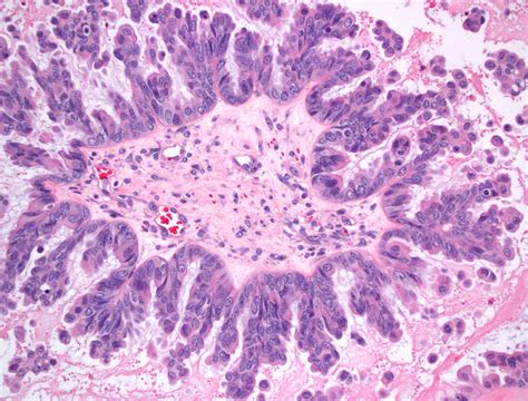 A Serous Borderline Ovarian Tumor With Micropapillary Feat Flickr
